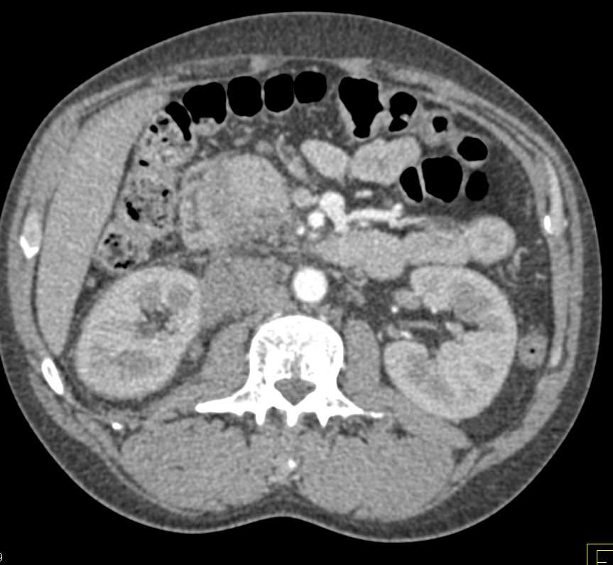 Lymphoma Involves the Right Kidney - CTisus CT Scan