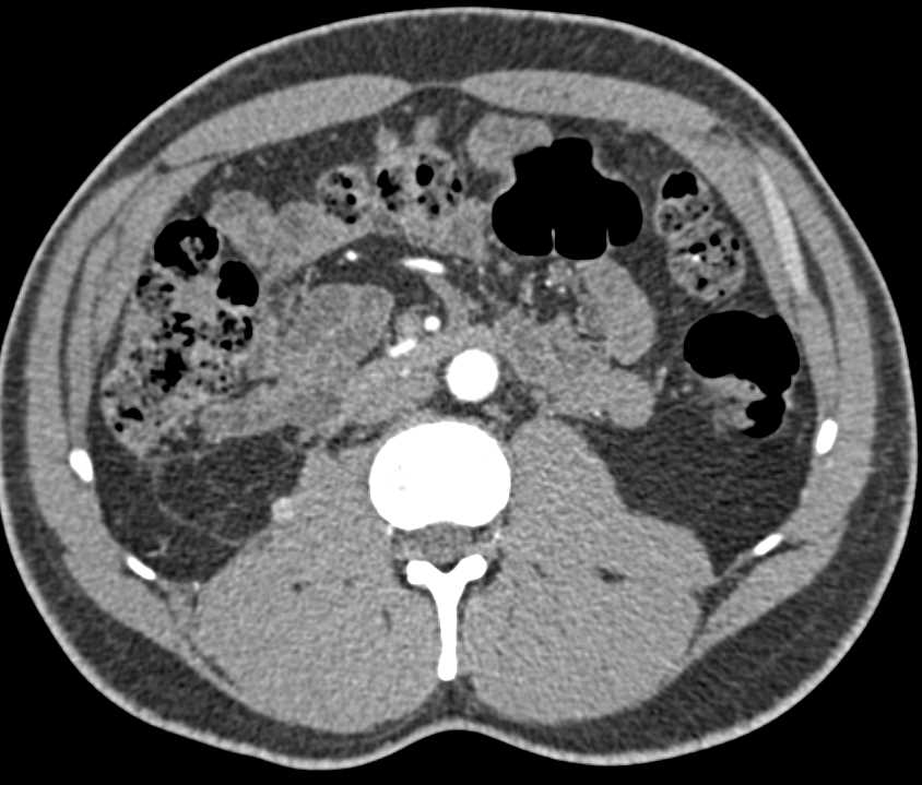 Renal infarct with Inflammation - CTisus CT Scan