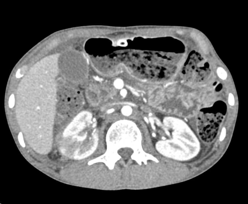 Acute Pyelonephritis - CTisus CT Scan