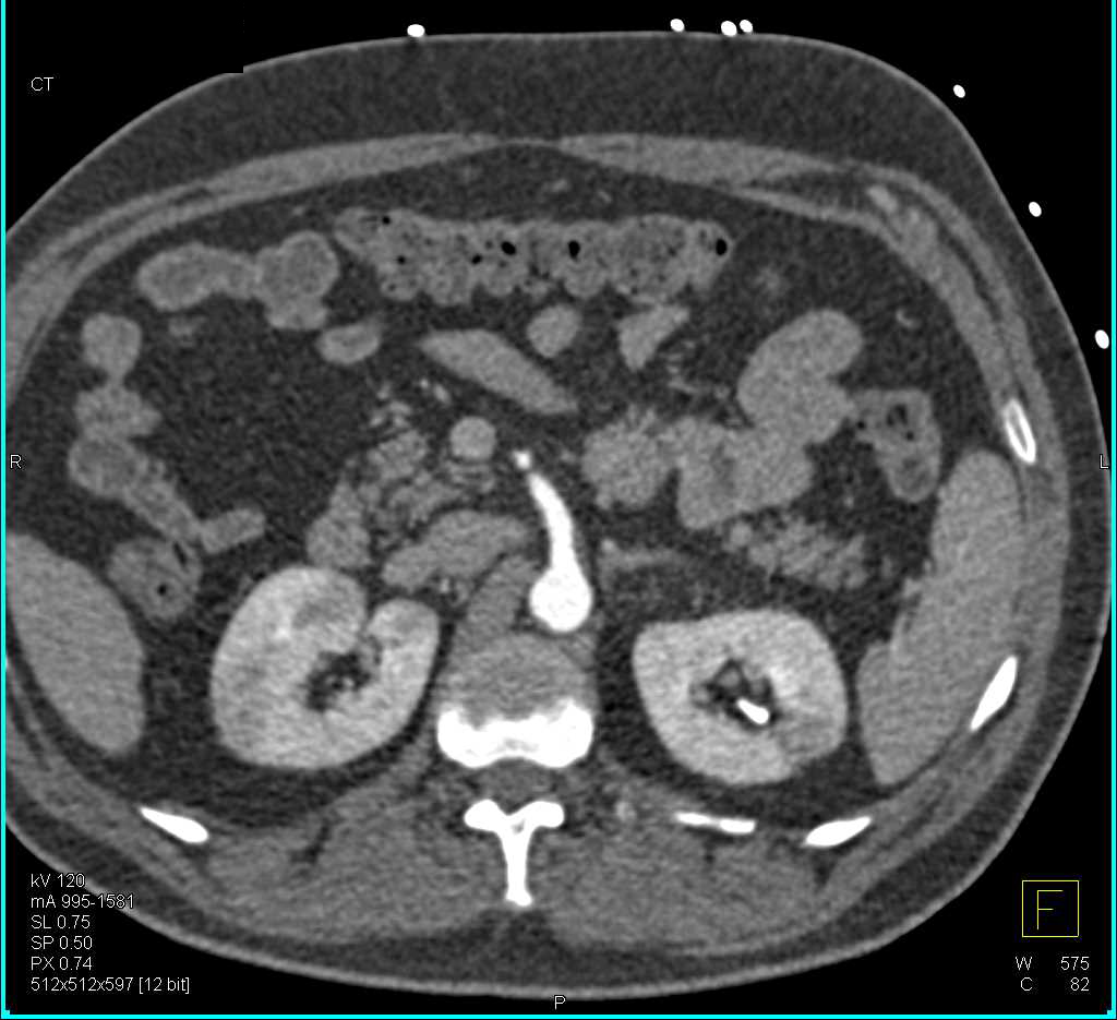 Acute Pyelonephritis Both Kidneys - CTisus CT Scan