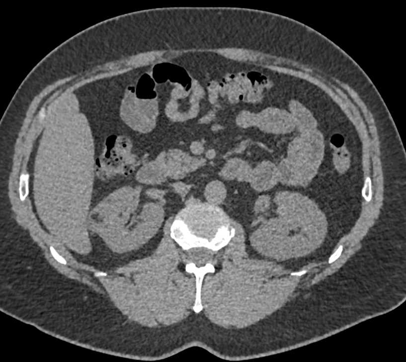 Bilateral Renal Angiomyolipomas - CTisus CT Scan