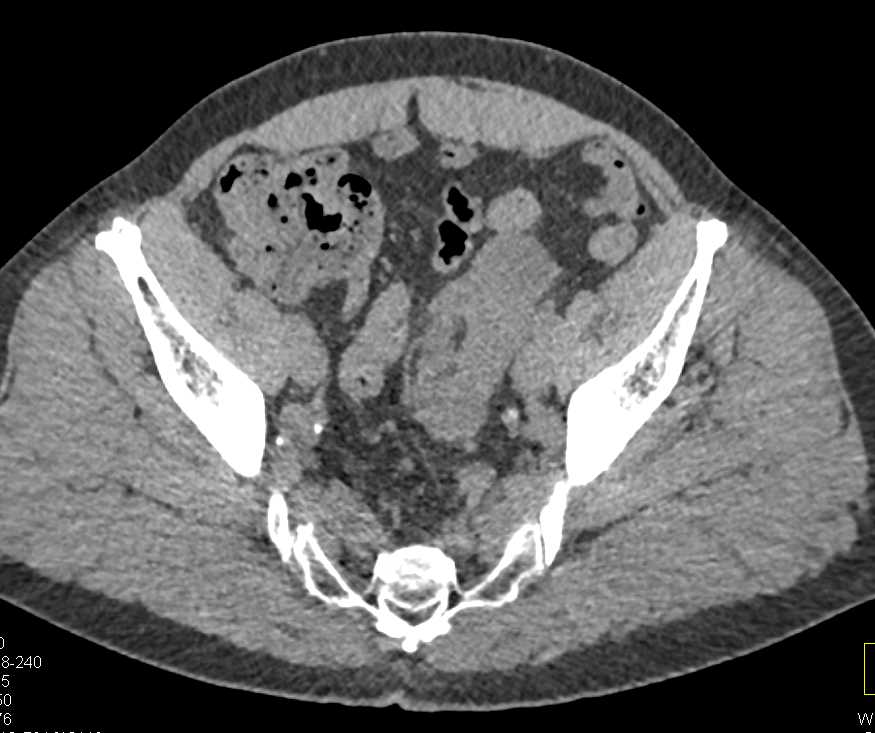 Papillary Renal Cell Carcinoma in a Left Pelvic Kidney - CTisus CT Scan