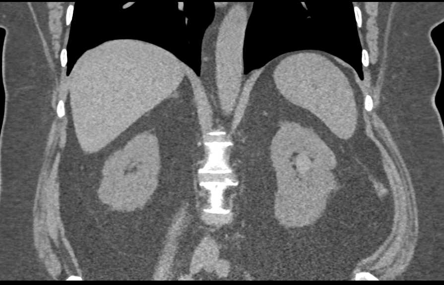 Transitional Cell Cancer (TCC) Left Kidney - CTisus CT Scan