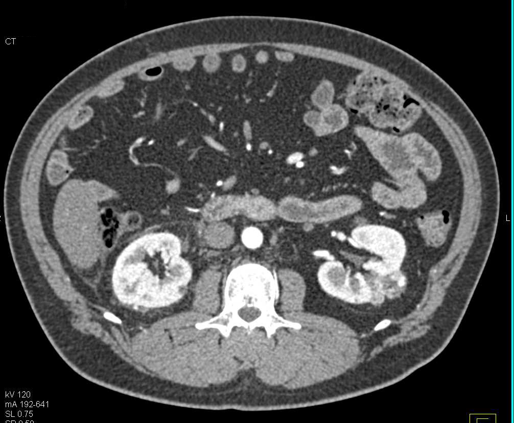 Bilateral Renal Cell Carcinomas - CTisus CT Scan