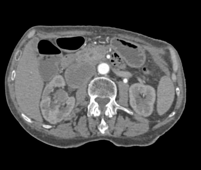 Renal Cell Carcinoma with Inferior Vena Cava (IVC) Involvement - CTisus CT Scan