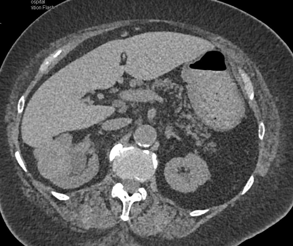 Clear Cell Carcinoma Right Kidney - CTisus CT Scan