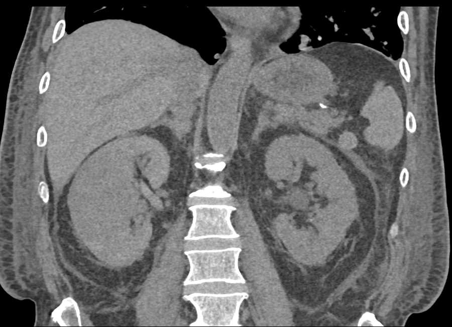 Transitional Cell Carcinoma Right Kidney Extends into the Renal Vein and Inferior Vena Cava (IVC) - CTisus CT Scan