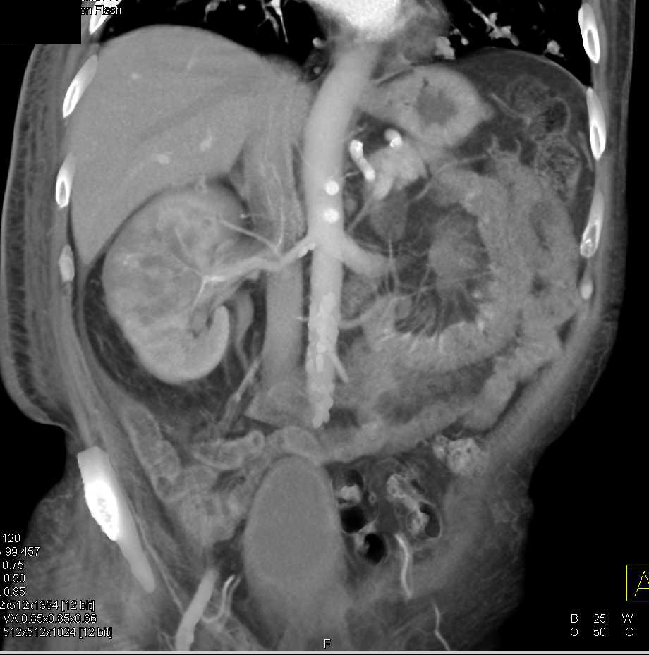 Transitional Cell Carcinoma Right Kidney Extends into the Renal Vein and Inferior Vena Cava (IVC) - CTisus CT Scan