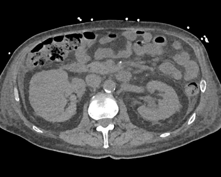 Transitional Cell Carcinoma Right Kidney Extends into the Renal Vein and Inferior Vena Cava (IVC) - CTisus CT Scan