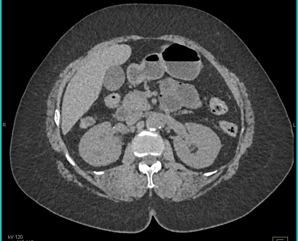 Transitional Cell Carcinoma Upper Pole Right Kidney - CTisus CT Scan