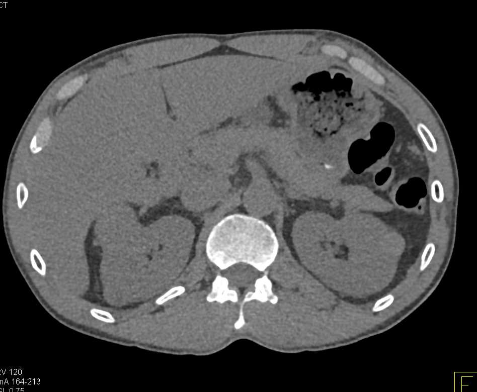 Papillary Renal Cell Carcinoma Right Kidney - CTisus CT Scan