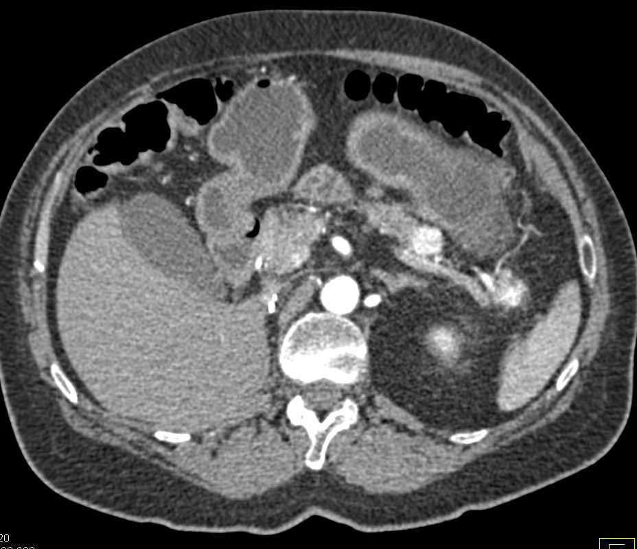 Clear Cell Renal Cell Carcinoma with Right Nephrectomy and Metastases to Contralateral Kidney and Pancreas - CTisus CT Scan