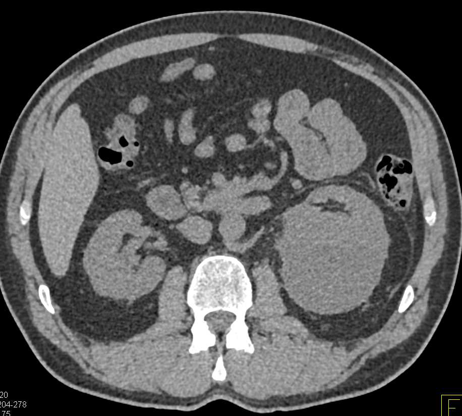 Subcapsular Bleed Left Kidney with Page Kidney Appearance - CTisus CT Scan