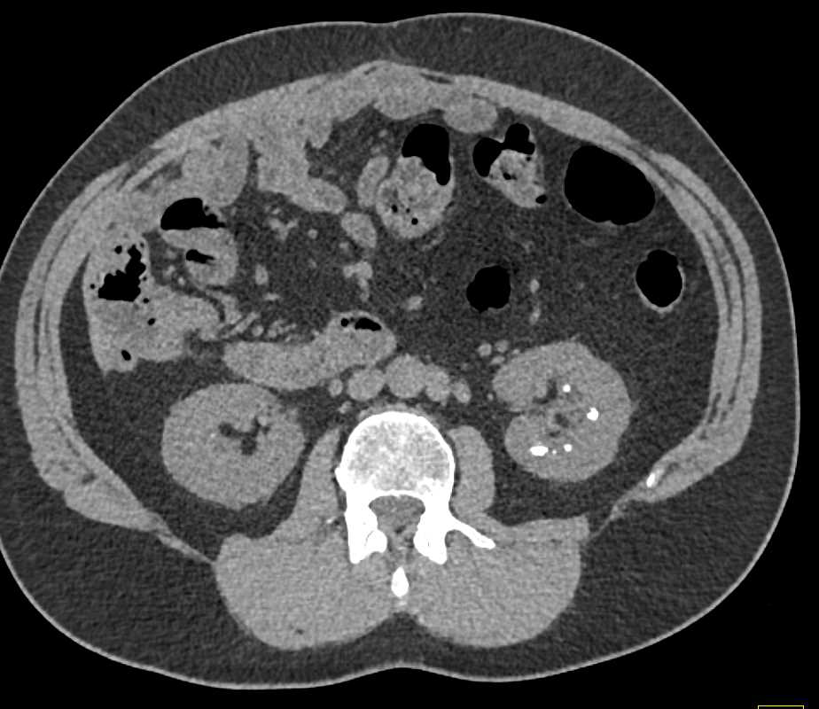 Medullary Sponge Kidney - CTisus CT Scan