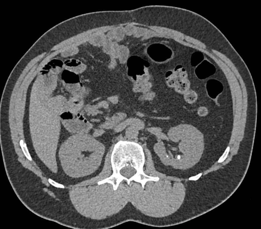 Medullary Sponge Kidney - CTisus CT Scan