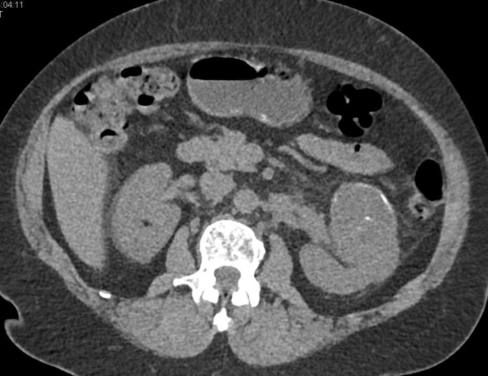 Cystic Left Renal Cell Carcinoma - CTisus CT Scan