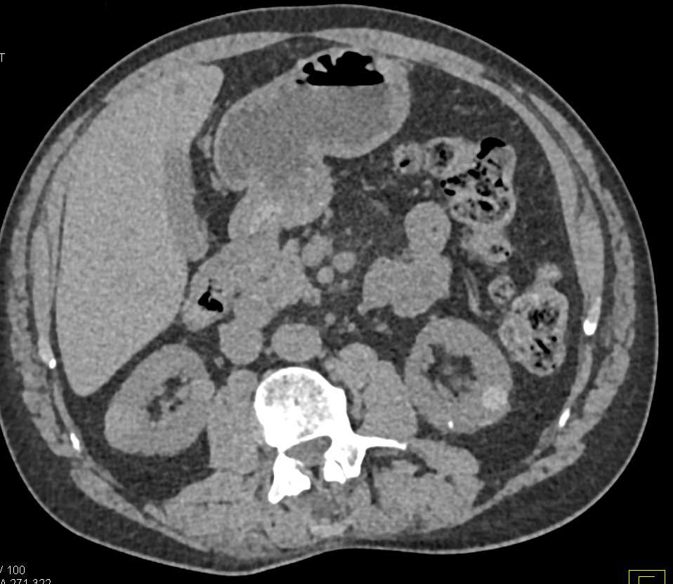 Multiple High Density Renal Cysts - CTisus CT Scan