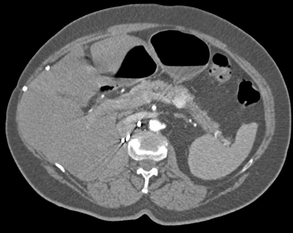 Metastatic Clear Cell Renal Cell Carcinoma to Pancreas and Contralateral Kidney - CTisus CT Scan