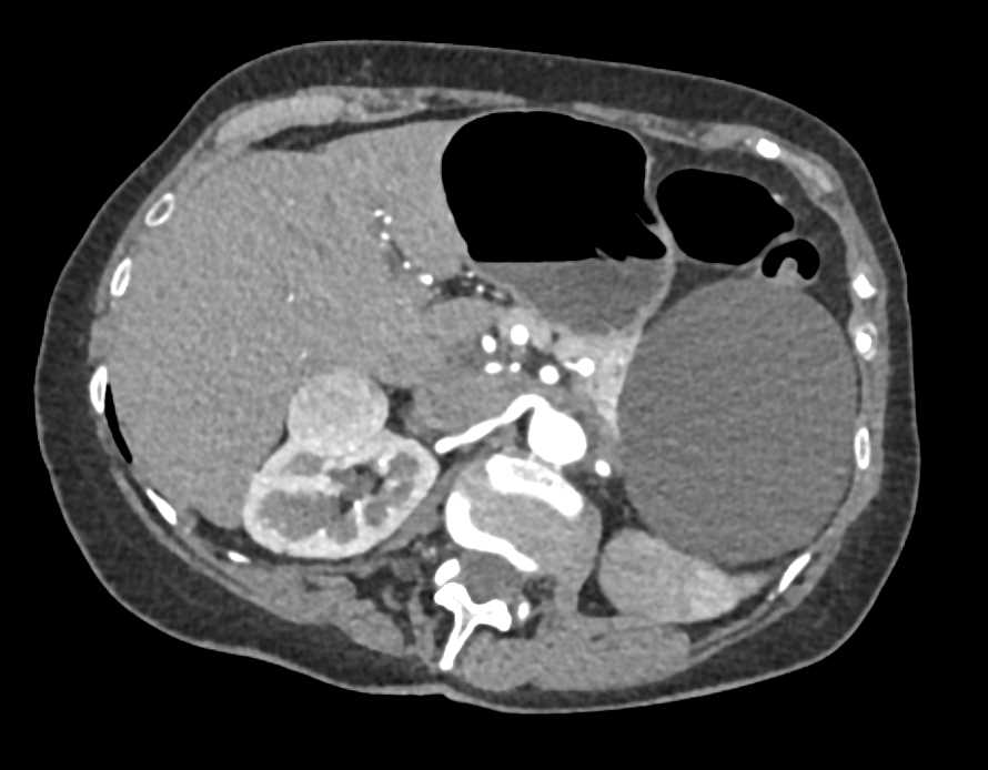 Oncocytoma Right Kidney - CTisus CT Scan