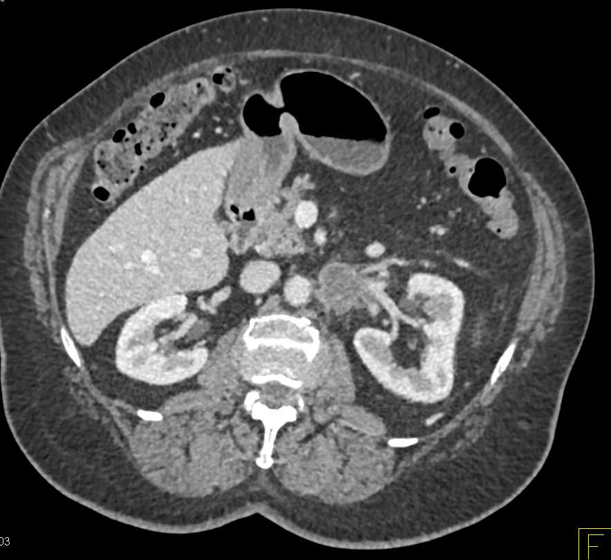 Tumor Invades Into the Left Renal Vein - CTisus CT Scan