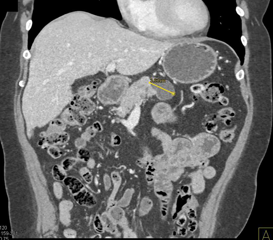 Metastatic Renal Cell Carcinoma with Pancreatic Metastases - CTisus CT Scan