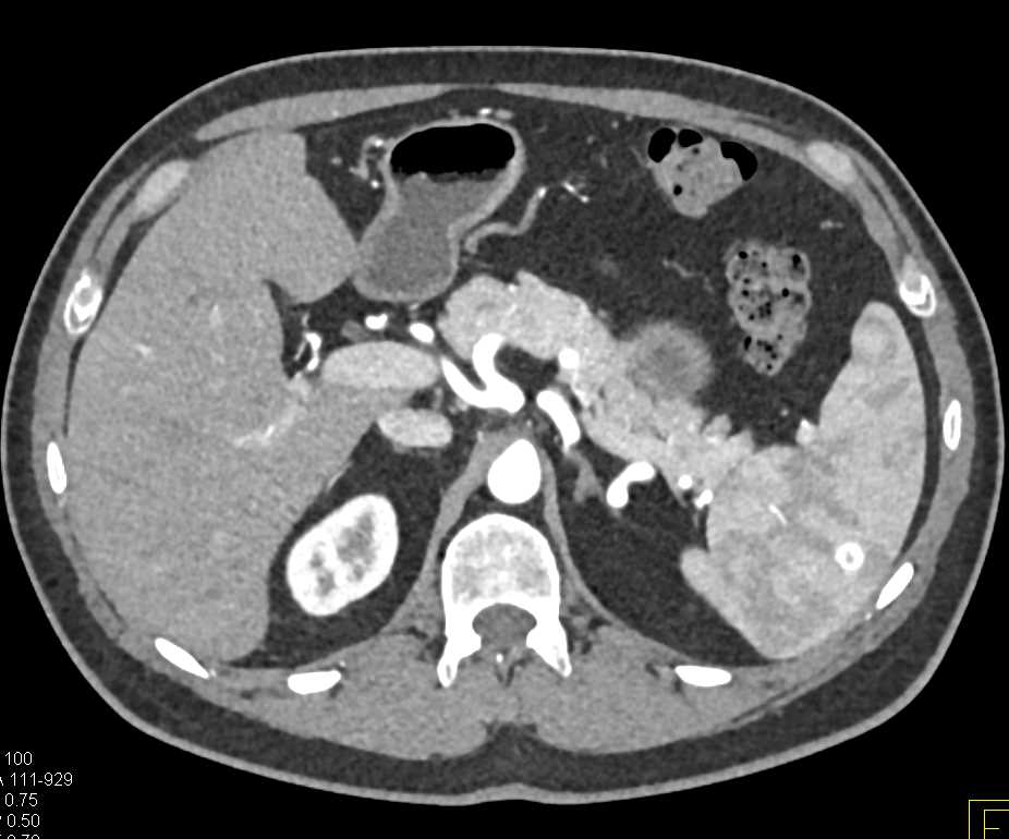 Right Hydronephrosis and Duodenal Adenocarcinoma - CTisus CT Scan