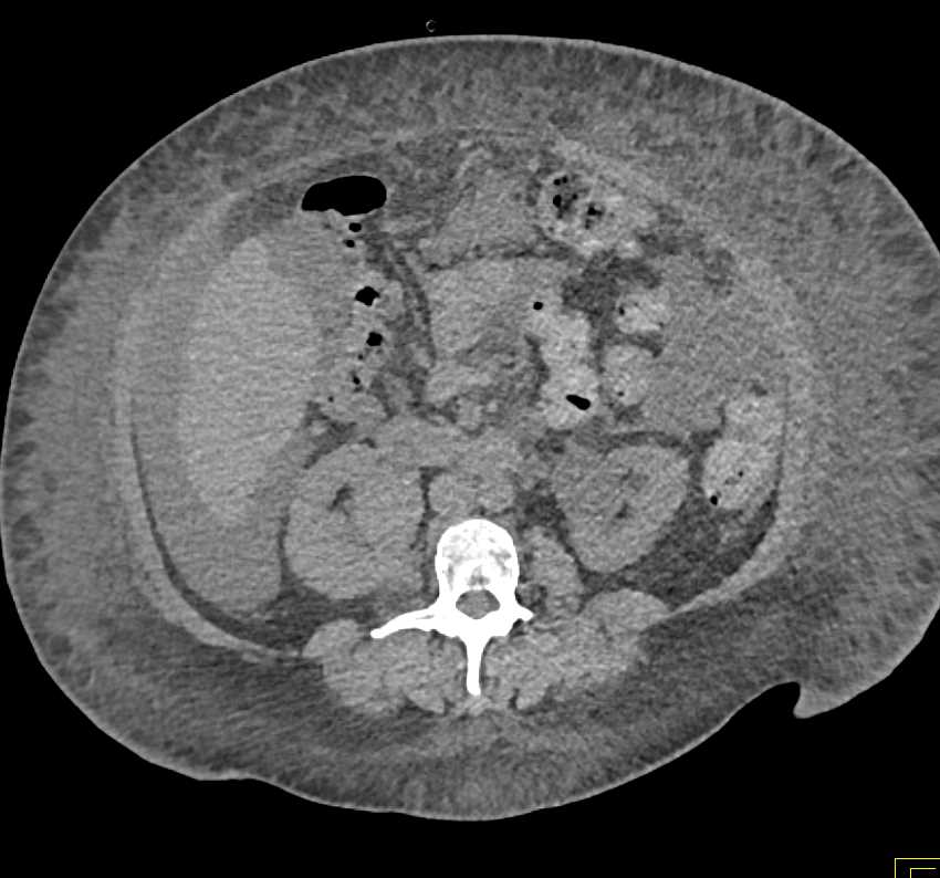 Incidental Right Papillary Renal Cell Carcinoma (RCC) - CTisus CT Scan