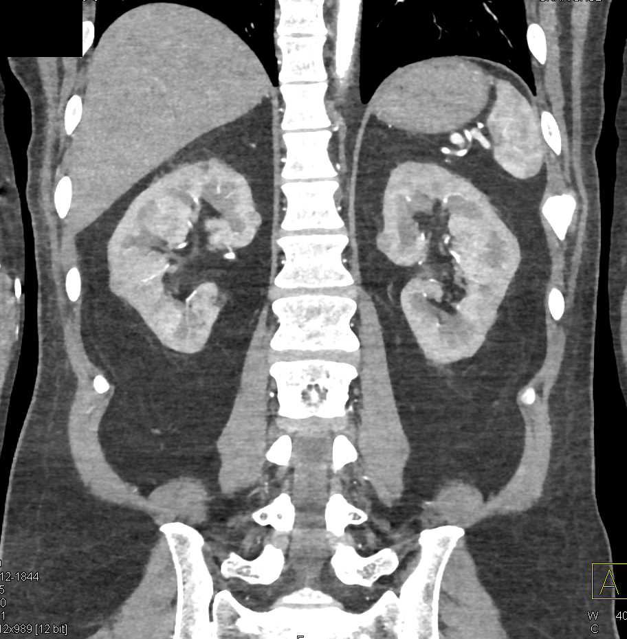 Bilateral Renal Cell Carcinomas - CTisus CT Scan