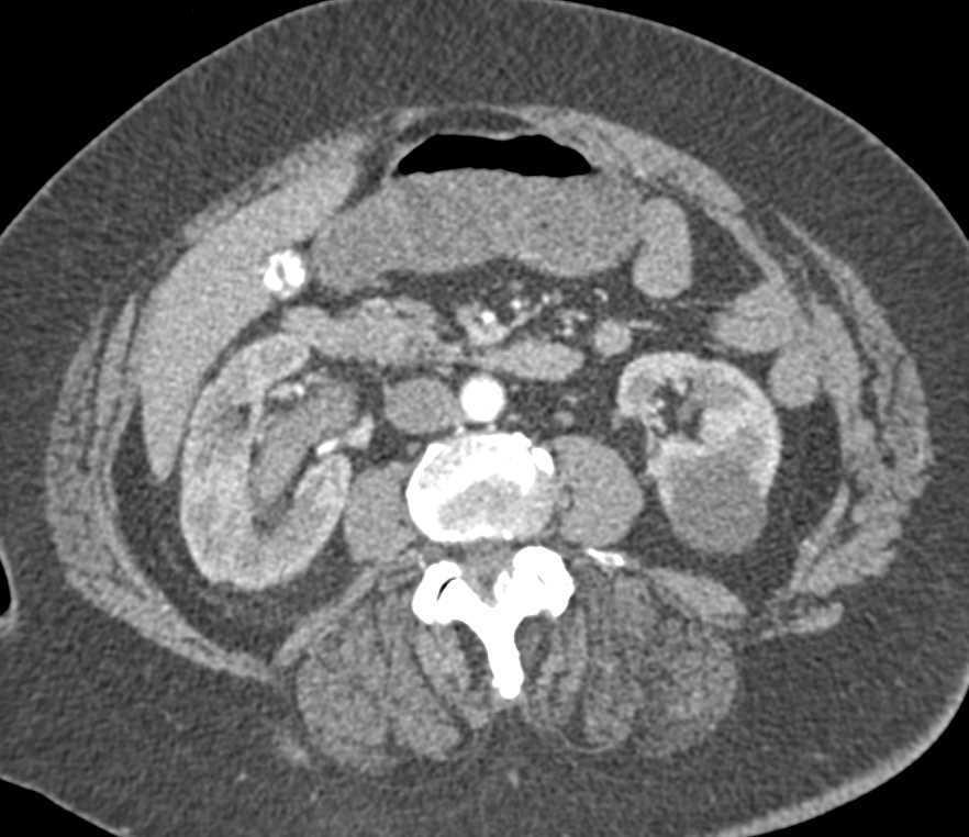 Transitional Cell Carcinoma Right Renal Pelvis - CTisus CT Scan