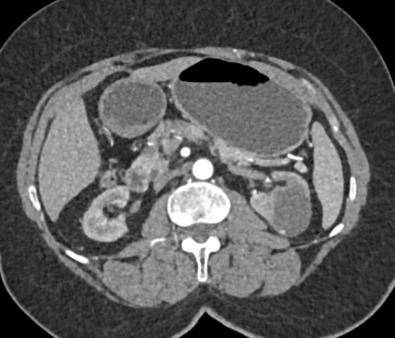 Enhancing 5mm Nodule in Left Renal Cyst - CTisus CT Scan