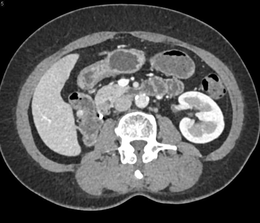 1cm Vascular Metastases Near Right Renal Bed in Patient with Renal Cell Carcinoma and Nephrectomy - CTisus CT Scan