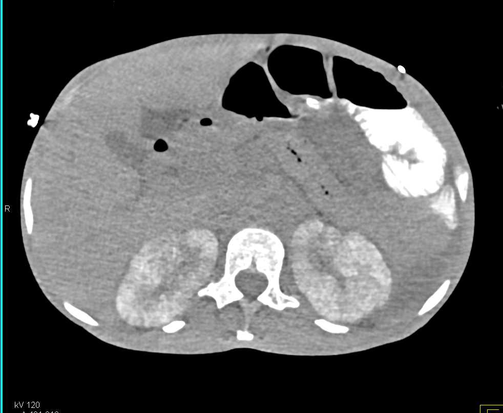 Striated Nephrogram in the Kidneys due to Infection - CTisus CT Scan