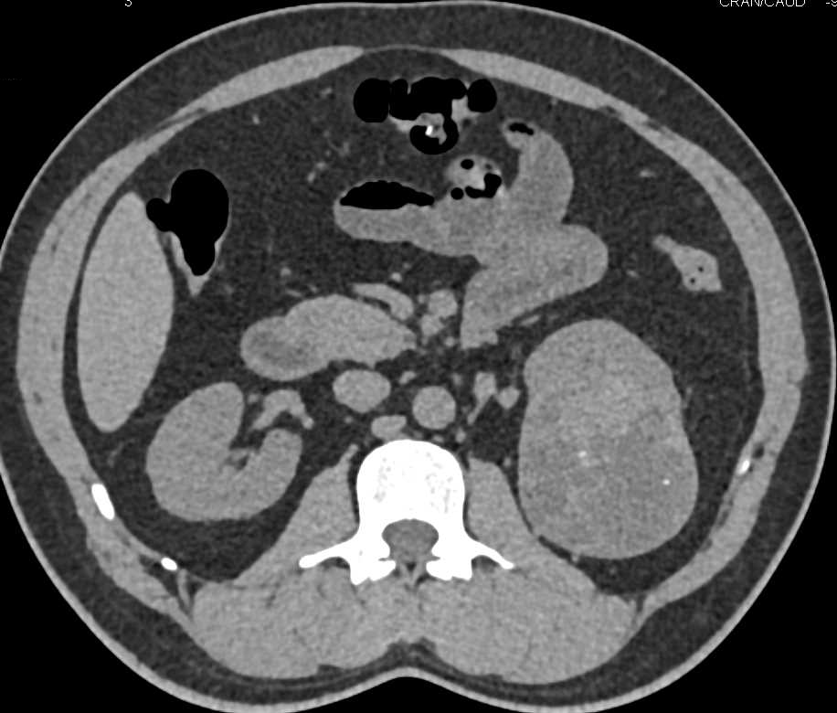 Clear Cell Renal Cell Carcinoma (RCC) with Neovascularity - CTisus CT Scan