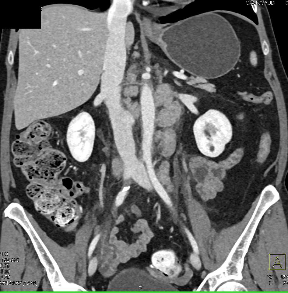 Angiomyolipoma Left Kidney in a Patient With Lymphoma - CTisus CT Scan