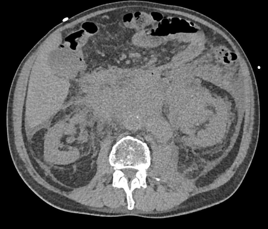 Lymphoma with Extensive Adenopathy and Infiltration of the Left Kidney - CTisus CT Scan