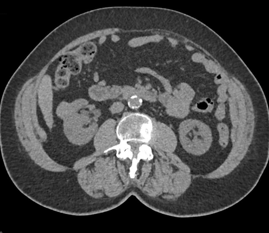 Papillary Renal Cell Carcinoma Right Kidney - CTisus CT Scan