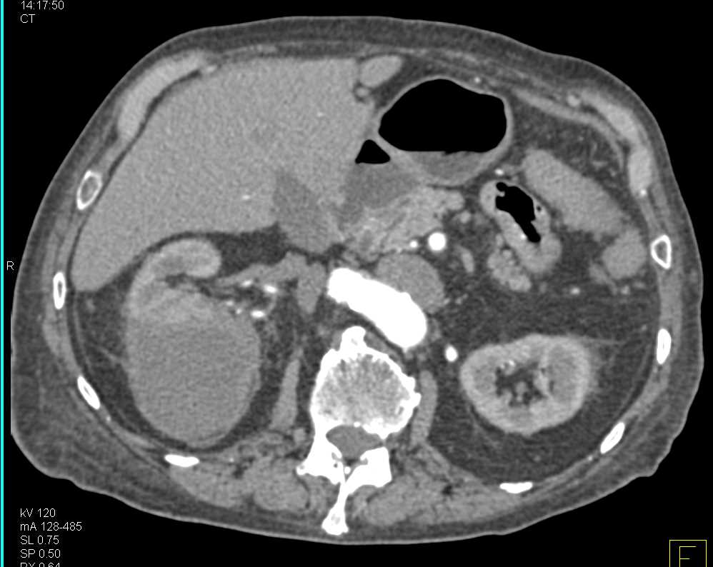 Perirenal Bleed Right Kidney - CTisus CT Scan