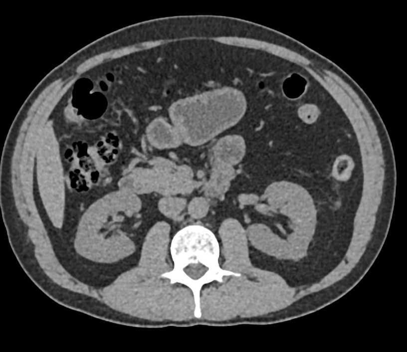 Papillary Renal cell carcinoma Left Kidney - CTisus CT Scan