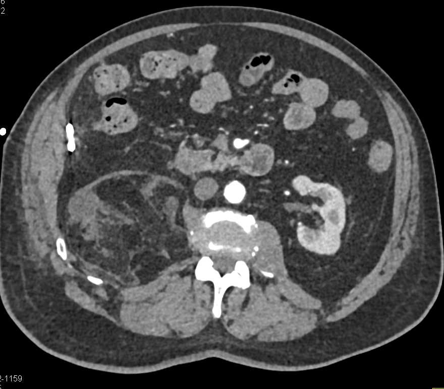 Perinephric Stranding Right Perirenal Space - CTisus CT Scan