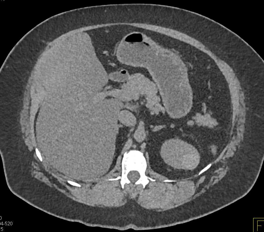 High Density Renal Cyst Left Kidney - CTisus CT Scan