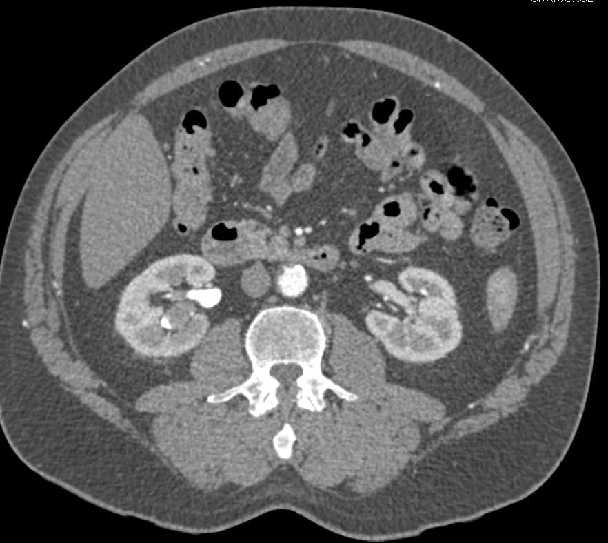 Transitional Cell Cancer (TCC) Right Renal Pelvis - Kidney Case Studies ...