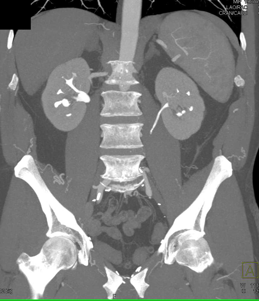 Transitional Cell Cancer (TCC) Right Renal Pelvis - CTisus CT Scan