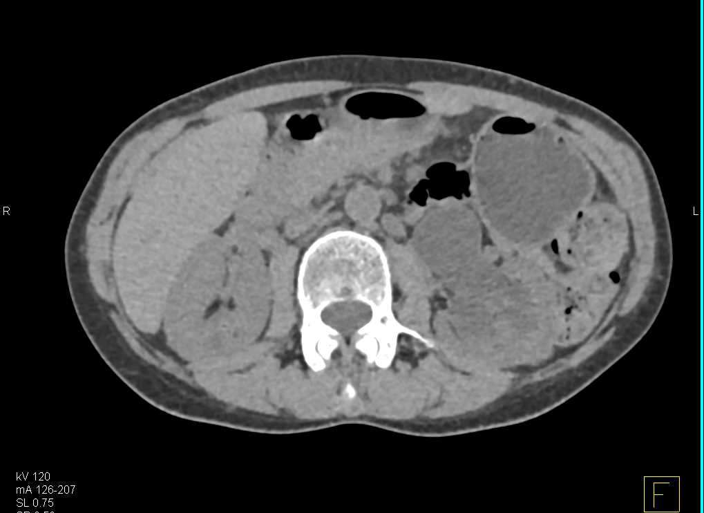 Ureteropelvic Junction (UPJ) Obstruction - CTisus CT Scan