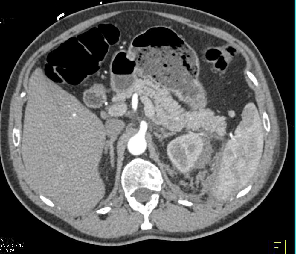 Inflammation Left Kidney due to Recent Stone Passage - CTisus CT Scan