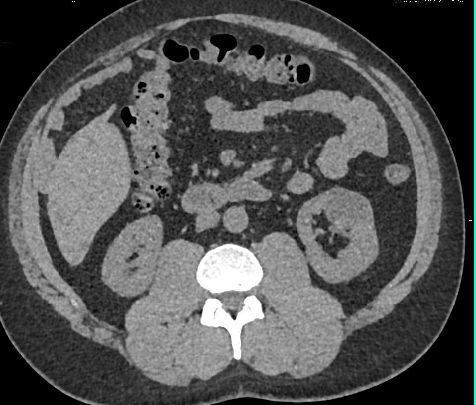 Calyceal Diverticulum Left Kidney Opacifies with Contrast - CTisus CT Scan