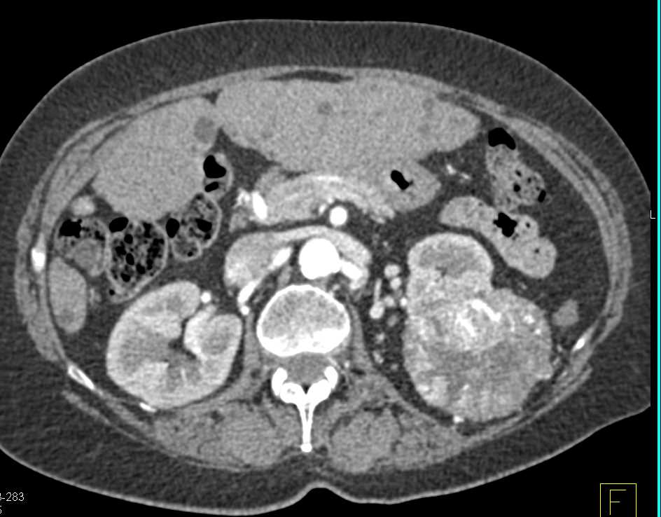 Clear Cell Renal Cell Carcinoma (RCC) with Neovascularity Left Kidney - CTisus CT Scan