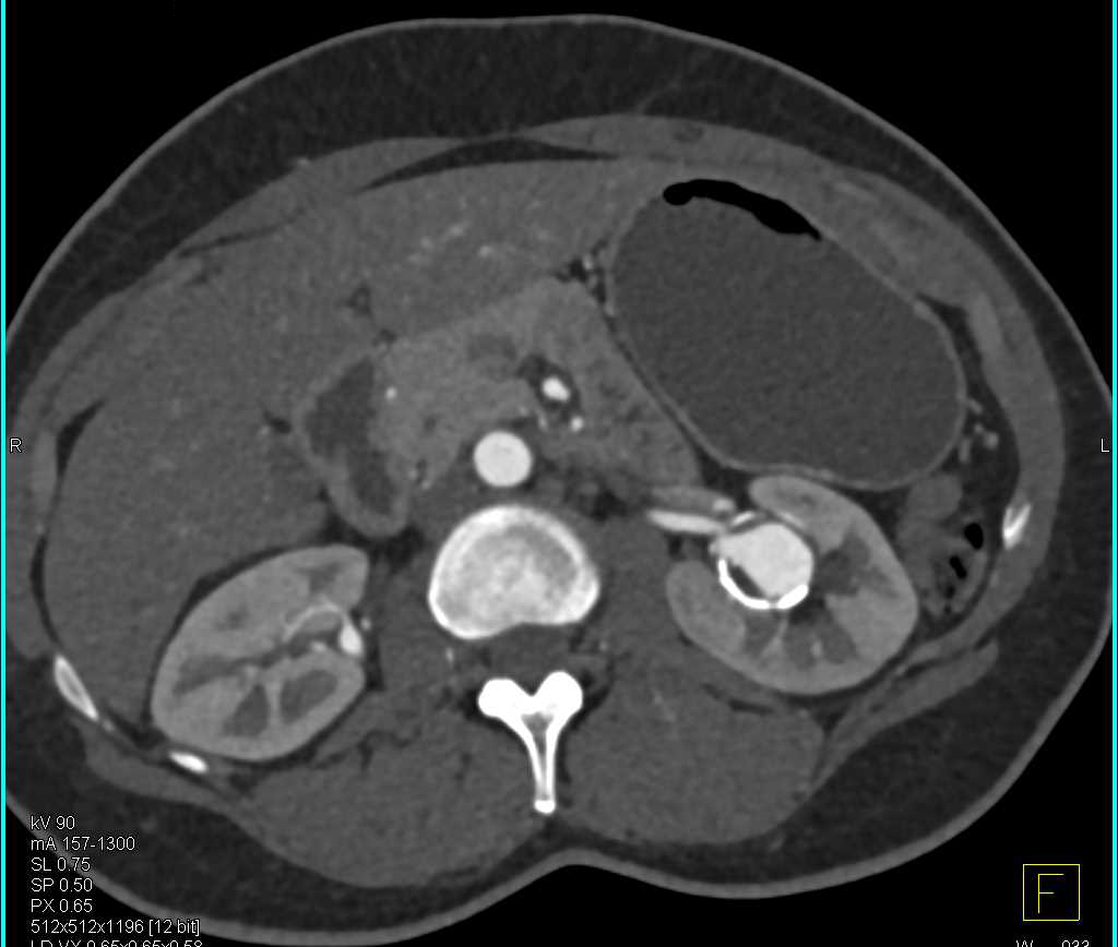 Left Renal Artery Aneurysm - CTisus CT Scan