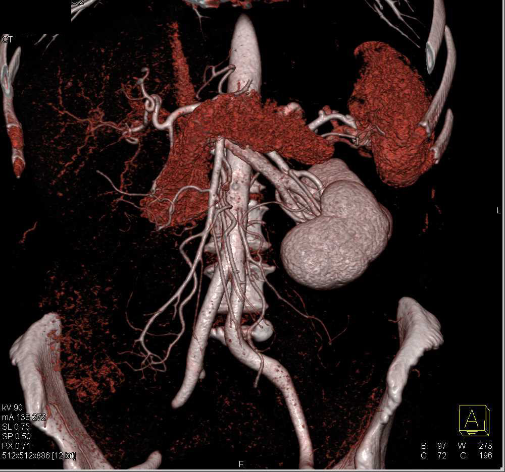 Prior Right Nephrectomy Without Recurrence - CTisus CT Scan