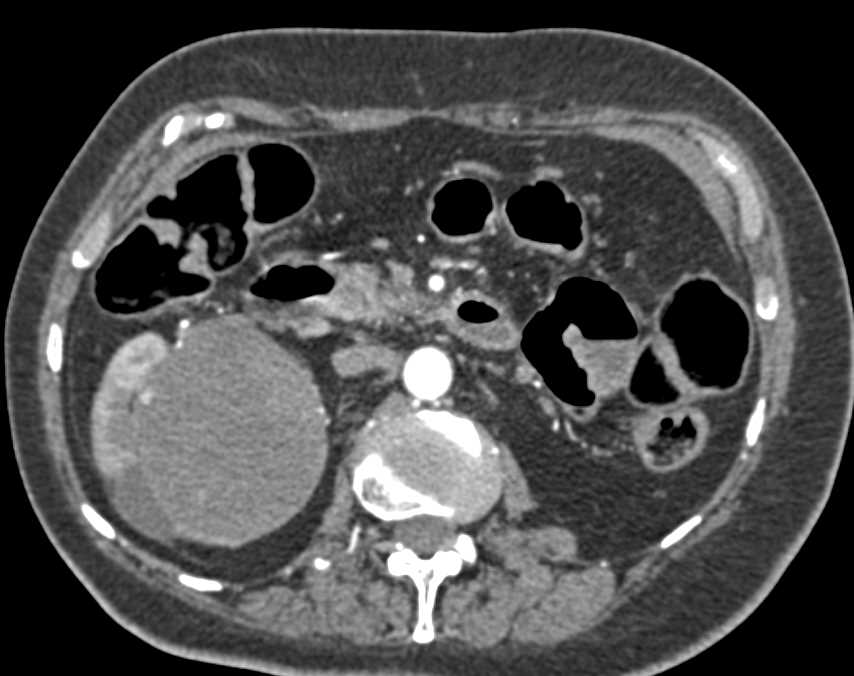 Cystic Renal Cell Carcinoma Right Kidney - CTisus CT Scan