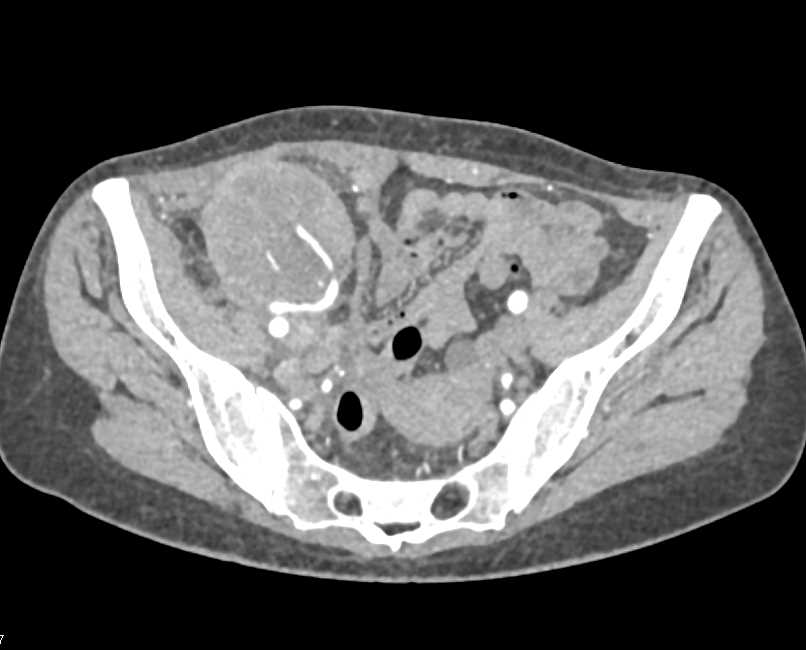 Failed Renal Transplant in the Right Lower Quadrant - CTisus CT Scan